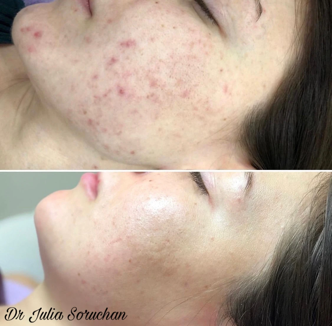 Tratamiento de acné - Antes y Después