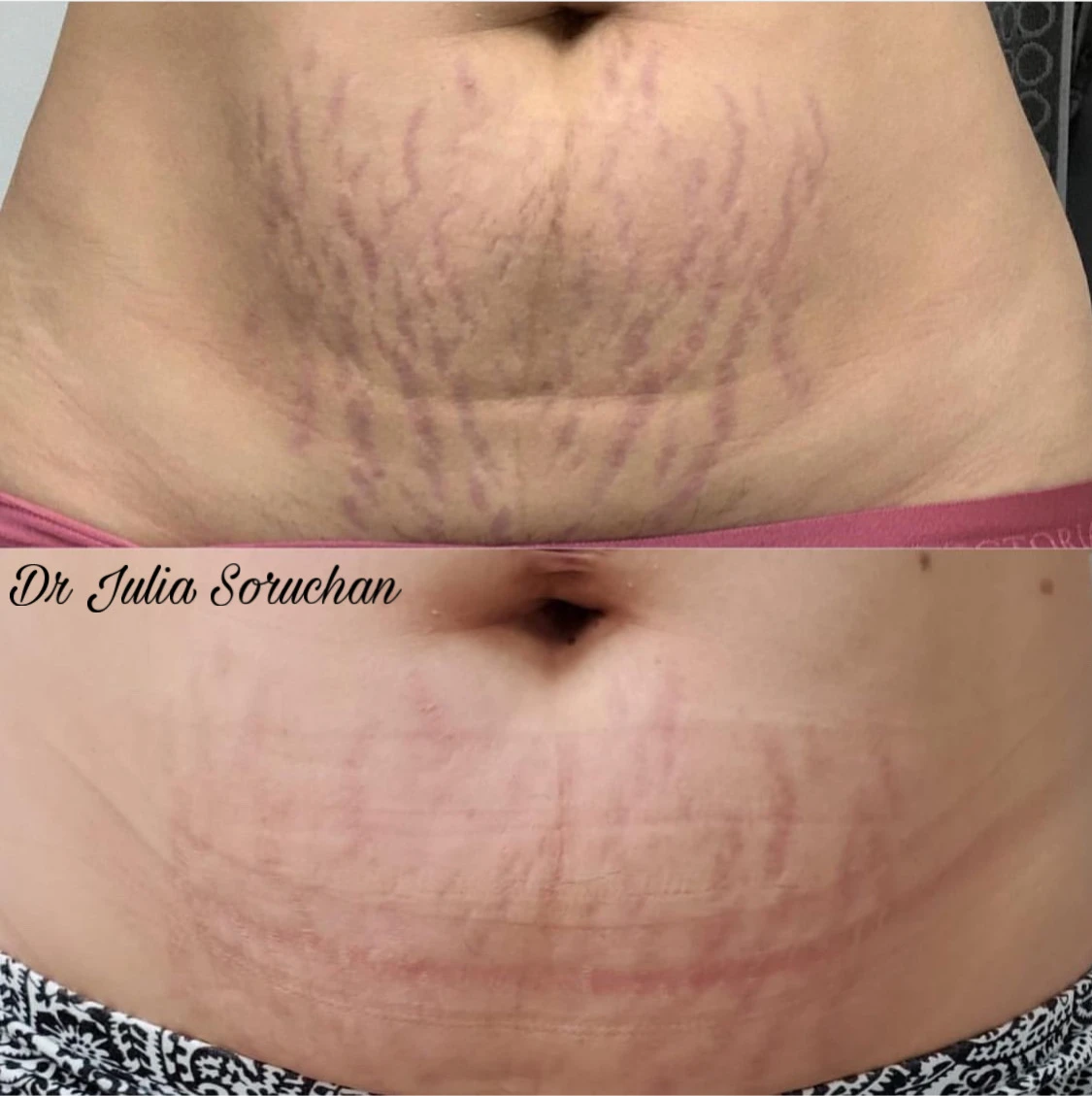 Tratamiento de estrías - Antes y Después