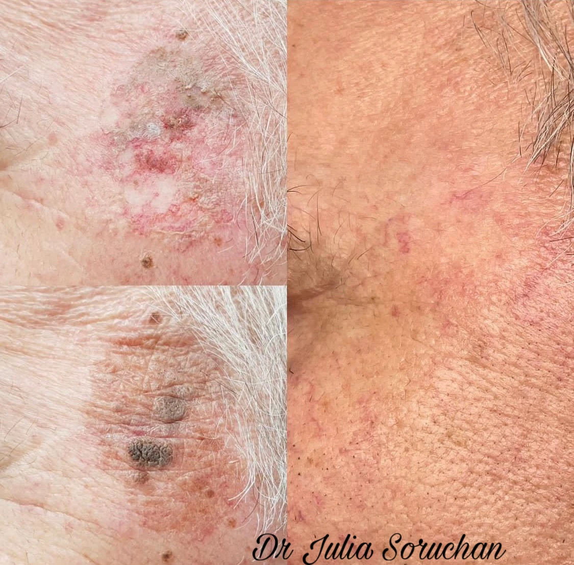 Tratamiento dermatológico - Antes y Después