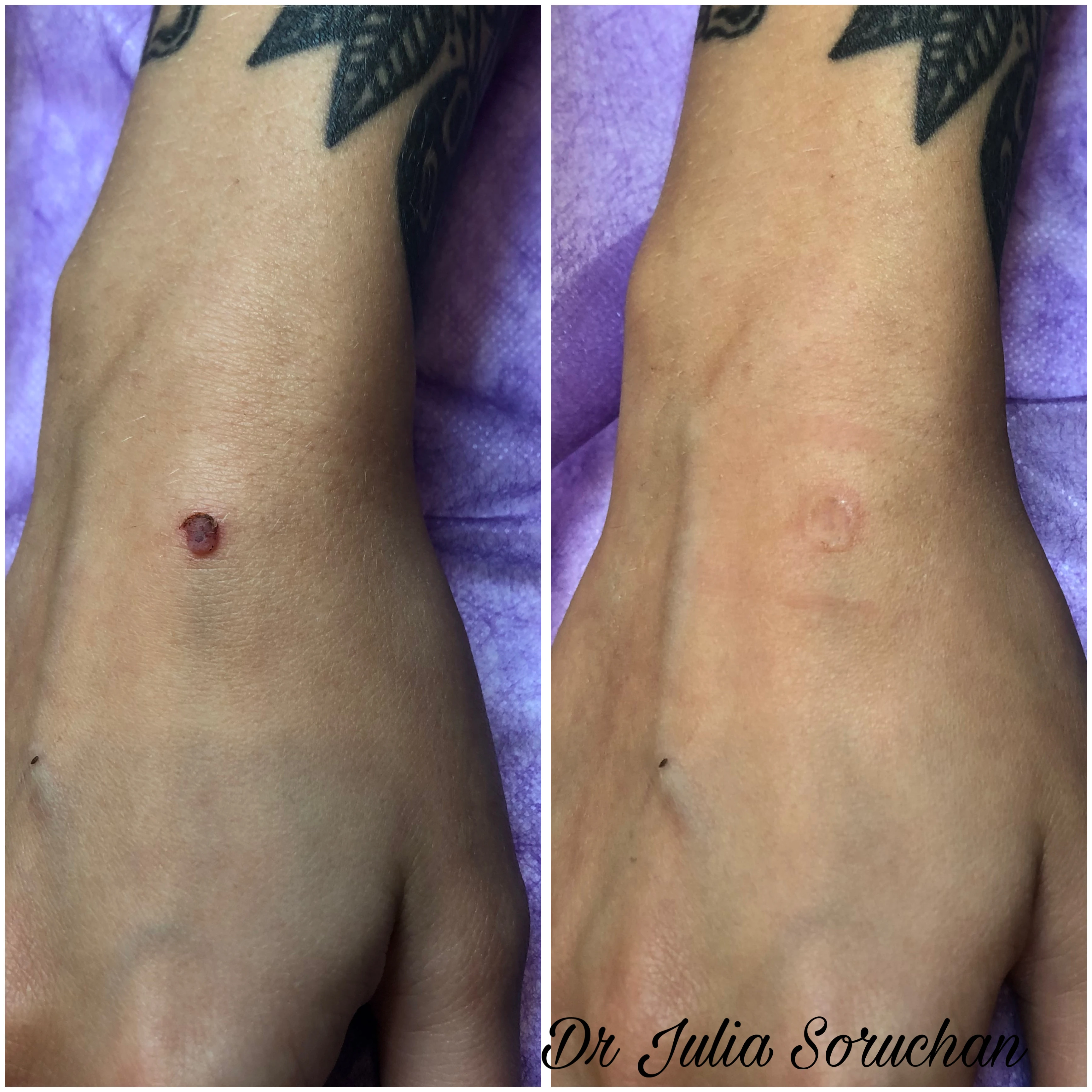 Eliminación de lesión - Antes y Después