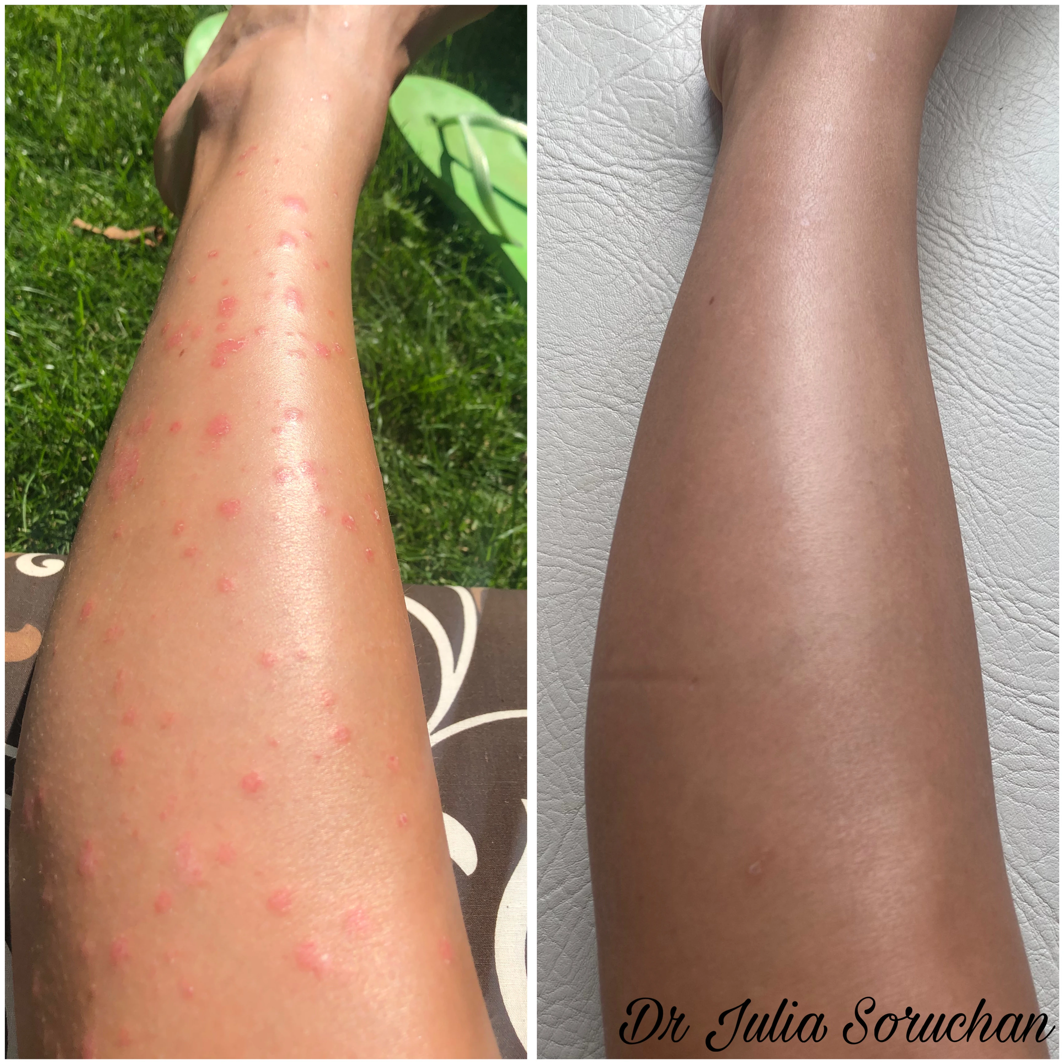 Tratamiento de piel - Antes y Después