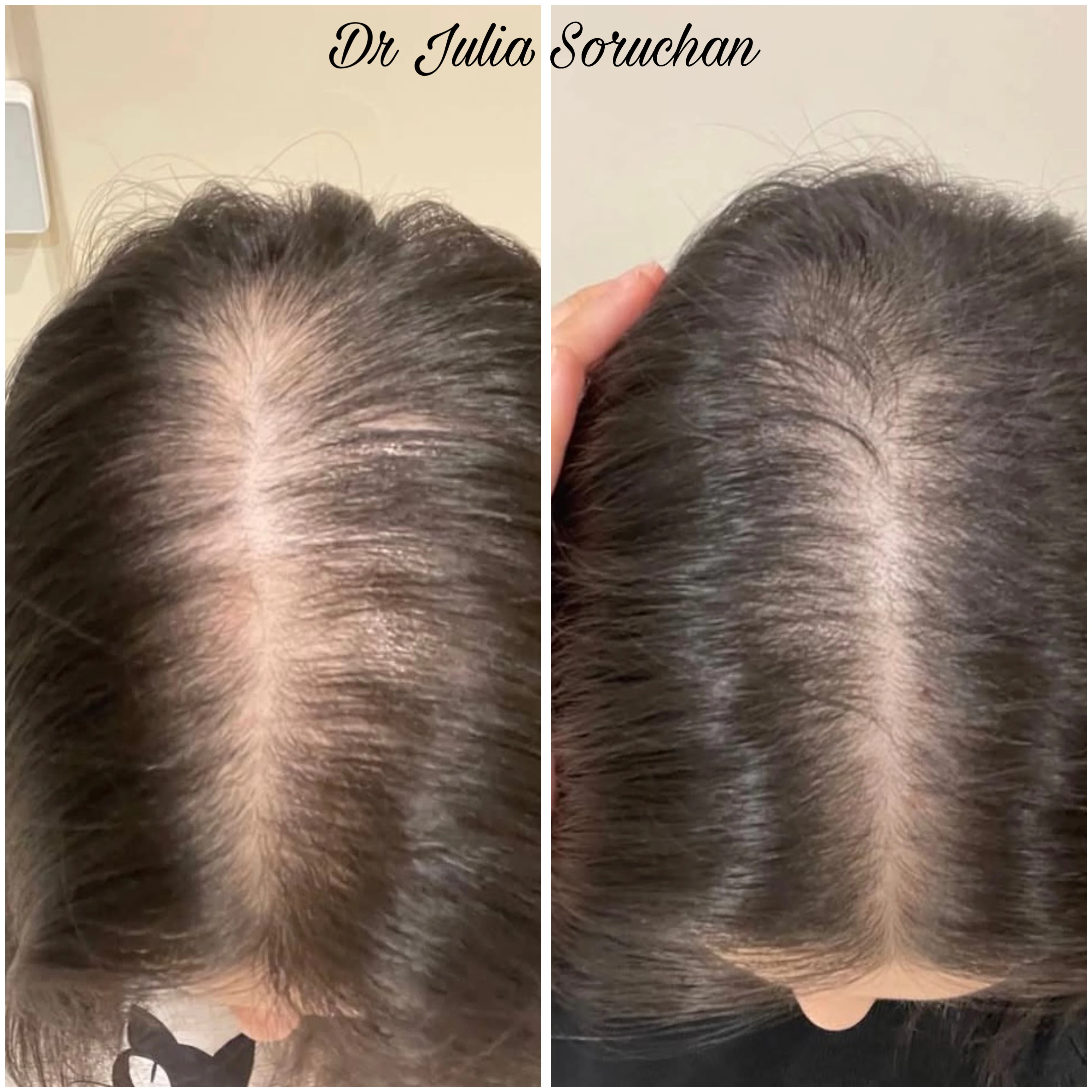 Tratamiento capilar - Antes y Después