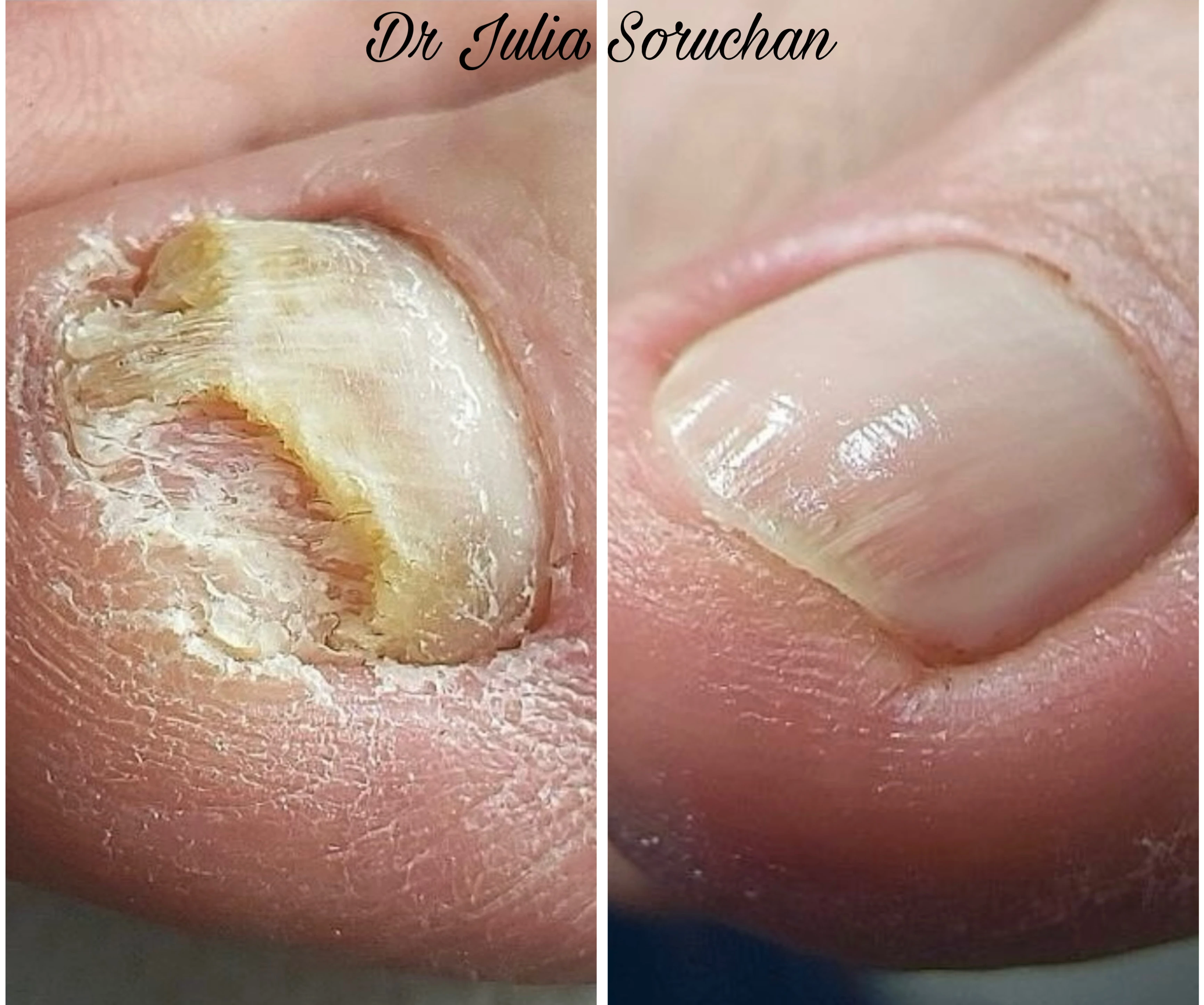 Tratamiento de uñas - Antes y Después