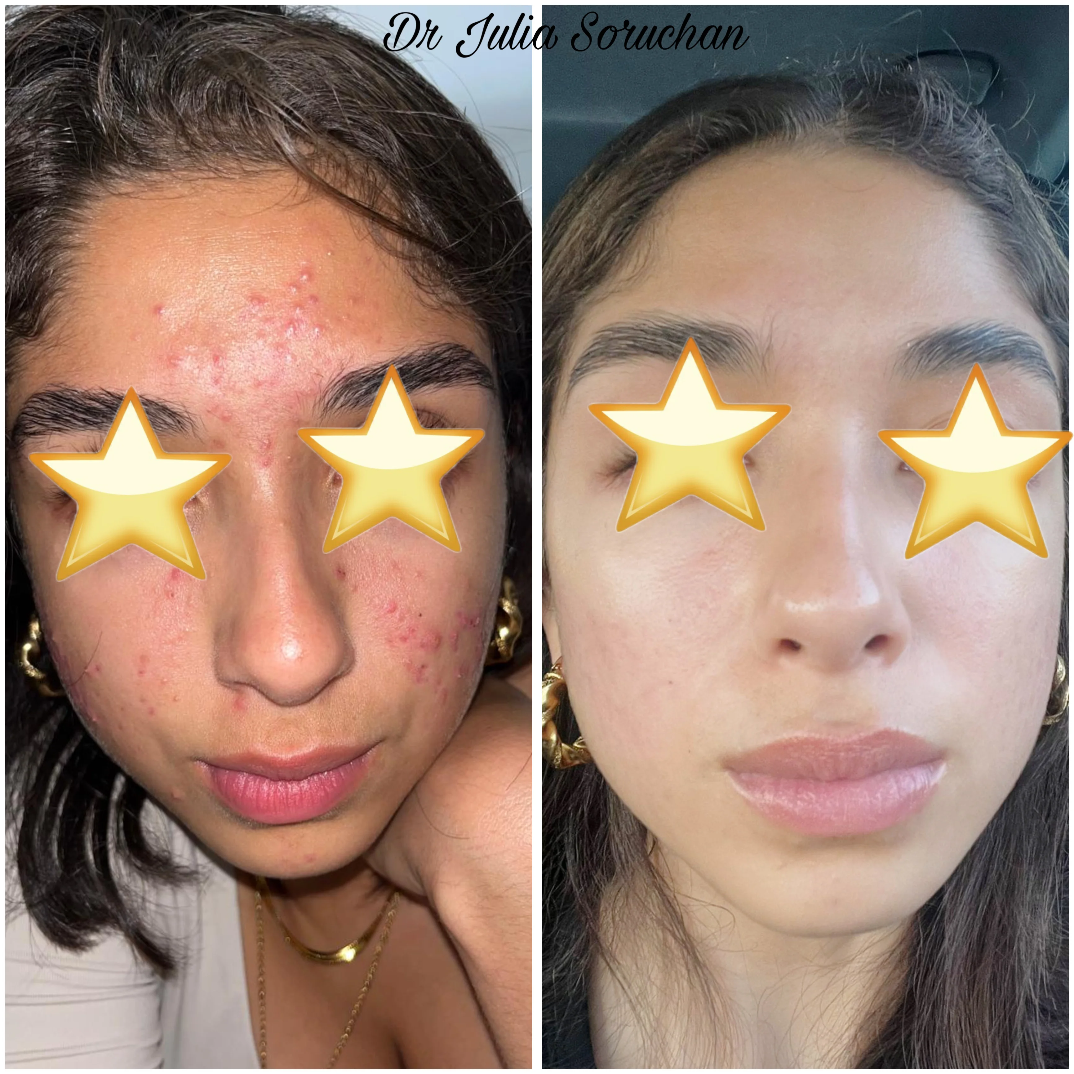 Tratamiento de acné facial - Antes y Después