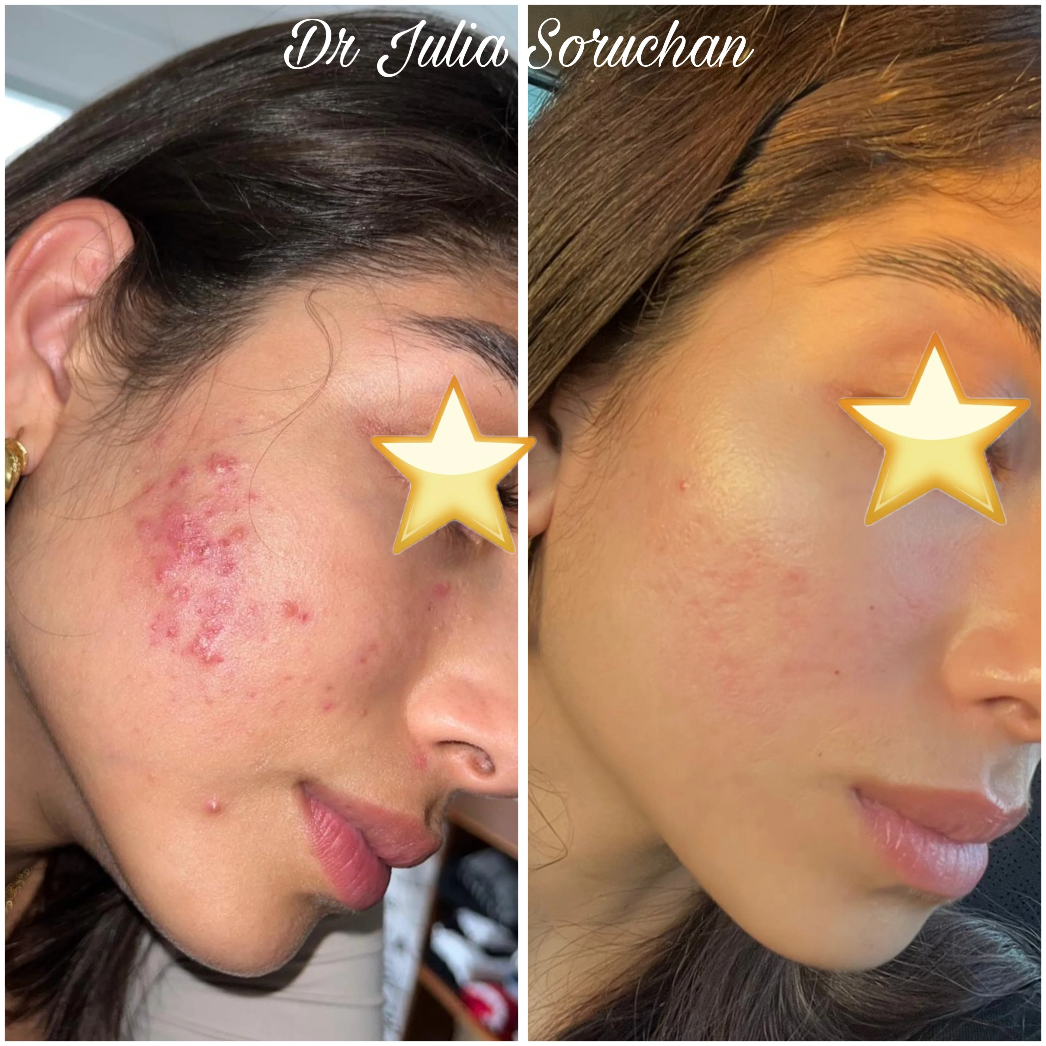 Tratamiento de acné facial (perfil) - Antes y Después